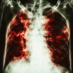 A x-ray of the chest shows a large amount of smoke.